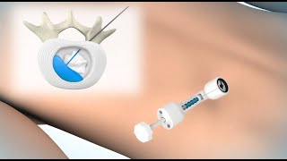 ReGelTec HYDRAFIL™ System by Amerra Medical 32,158 views 3 years ago 1 minute, 9 seconds