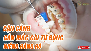 Cận cảnh quá trình gắn mắc cài kim loại tự buộc - KH Đ.T Châm