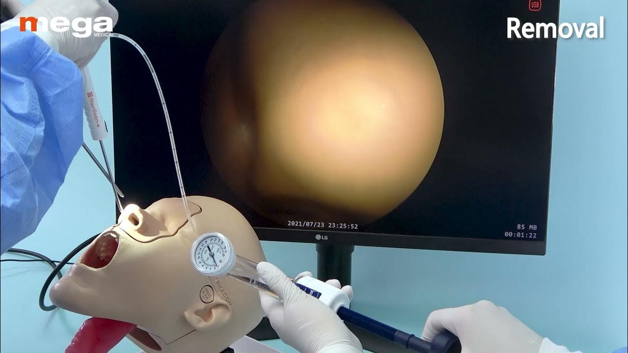 Navilloone Balloon Eustachian Tube Dilation Tips for use YouTube