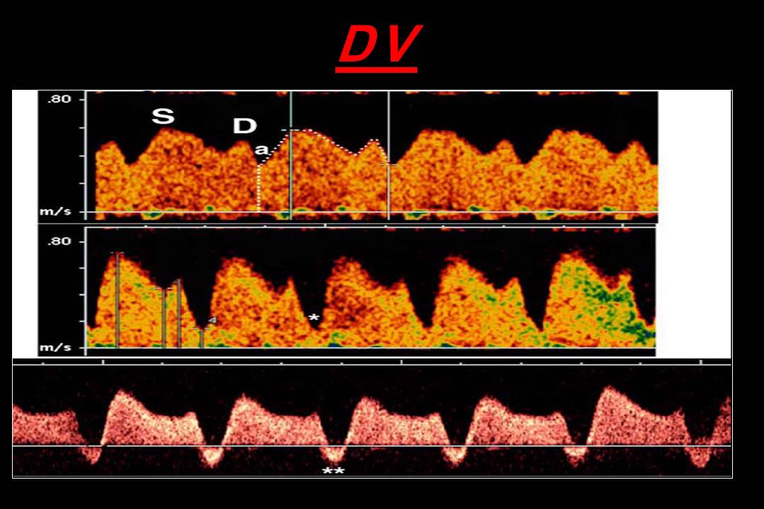 21 DOPPLER OF FETAL GROWTH RESTRICTION YouTube