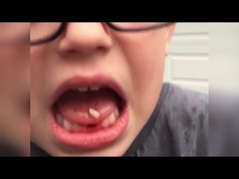 Video: Vantuzdan bir diş nasıl çıkar?