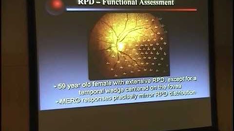 Towards a Refined Understading of the Genetics & Biology of Age-Related Macular Degeneration