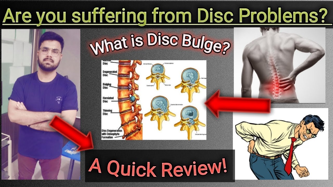 Are you Suffering from Disc Problems ? What is Disc Bulge? A quick ...