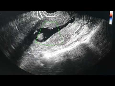 Video: Pembuangan Polip Uterus: Pembedahan, Dengan Atau Tanpa Anestesia, Pemulihan