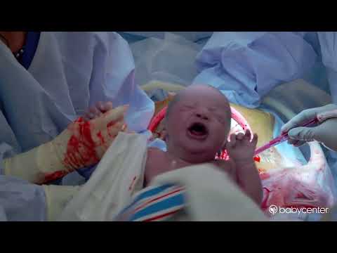 Live birth: C-section surgery