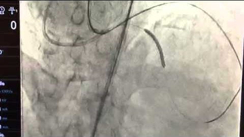 Ping-pong technique: Retrograd approach to total occlusion left anterior descending artery CTO-PCI