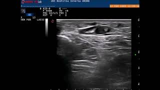 ULTRASOUND   Phlebitis, superficial venous thrombosis   Varicose vein screenshot 4
