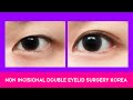 Non Incisional Double Eyelid Surgery Korea