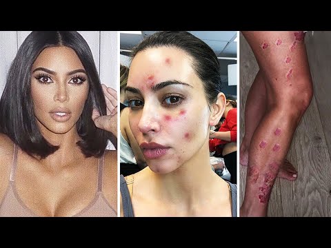 Видео: Ким Кардашьян пятна на лице