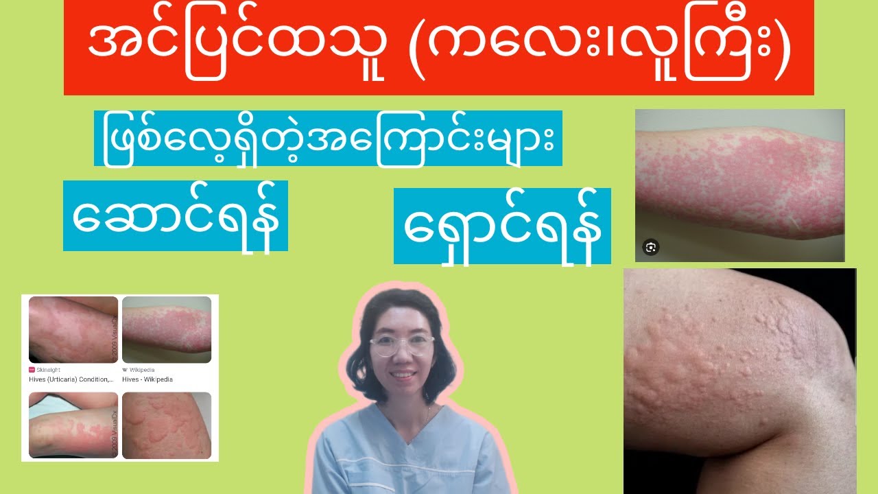 All about urticaria (children and adult) အင်ပြင်ထခြင်းအကြောင်း နှင့်ဆောင်ရန်ရှောင်ရန်