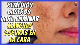 HOME REMEDIES TO REMOVE DARK SPOTS ON THE FACE