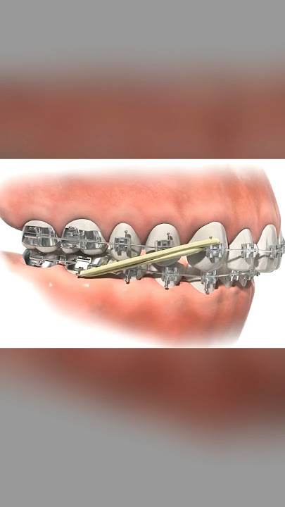 Class II elastics in Orthodontics #braces #teeth #dental #allaboutbraces