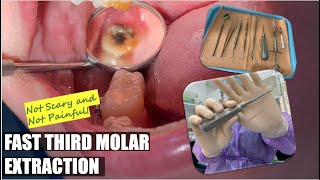 Fast Painless Simple Erupted Third Molar Extraction | Almost Step by Step | Apostol Dental PH