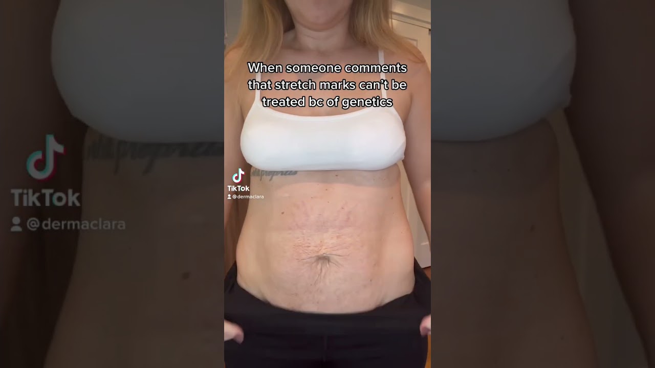 Say goodbye to stretch marks with reusable silicone patches 🥰