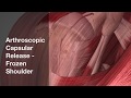 Arthroscopic Capsular Release for Frozen Shoulder