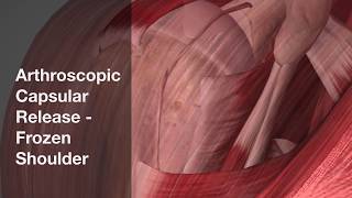 Arthroscopic Capsular Release for Frozen Shoulder