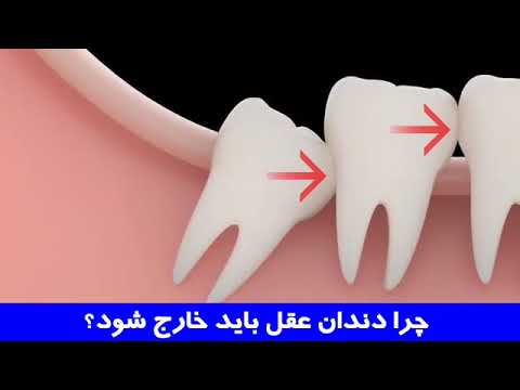 تصویری: چرا دندان عقل مورد نیاز است و آیا باید آن را خارج کرد ، از جمله در فک پایین