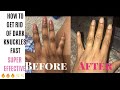 HOW TO GET RID OF DARK KNUCKLES, DARK ELBOW, DARK KNEES AND DARK FEETS