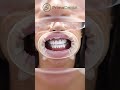 Primo Dental Veneer Smile Before/After #shorts