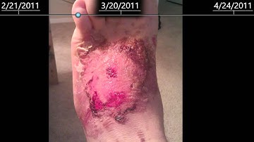 2nd Degree burns on foot - healing time lapse - 2 months