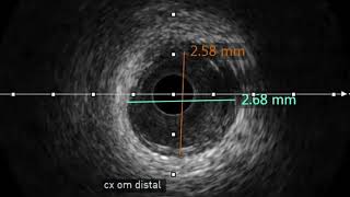 Video 4.4 CXA-OM CTO lezyonuna IVUS kılavuzlu DK nano-crush stentleme