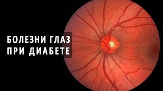 Сахарный диабет как причина глазных болезней Сахарный диабет как причина глазных болезней