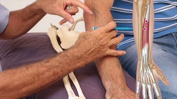 Trigger Points - Extensor Digitorum