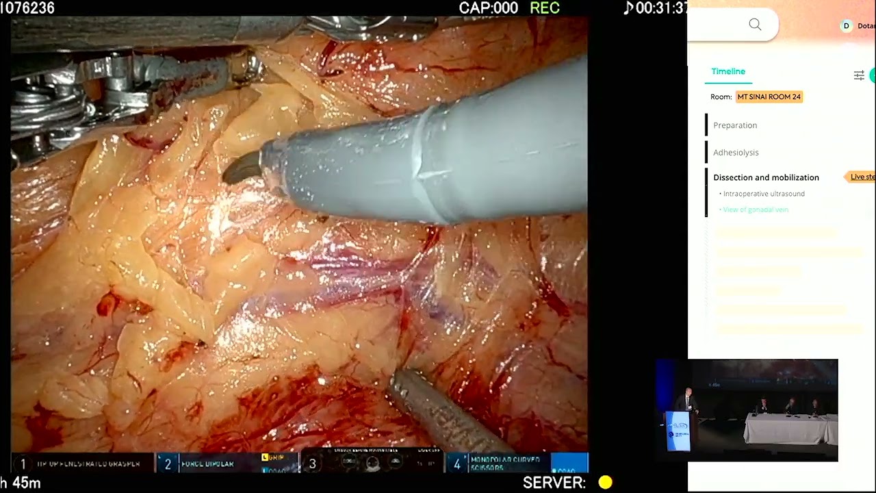 Robotic Partial Nephrectomy with Real-TIme Artificial Intelligence (AI) Annotation-Dr. Ketan Badani
