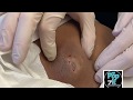Giant abscess 3 week follow up Most of sac removed and pocket packed Large sac removed. Cyst pop