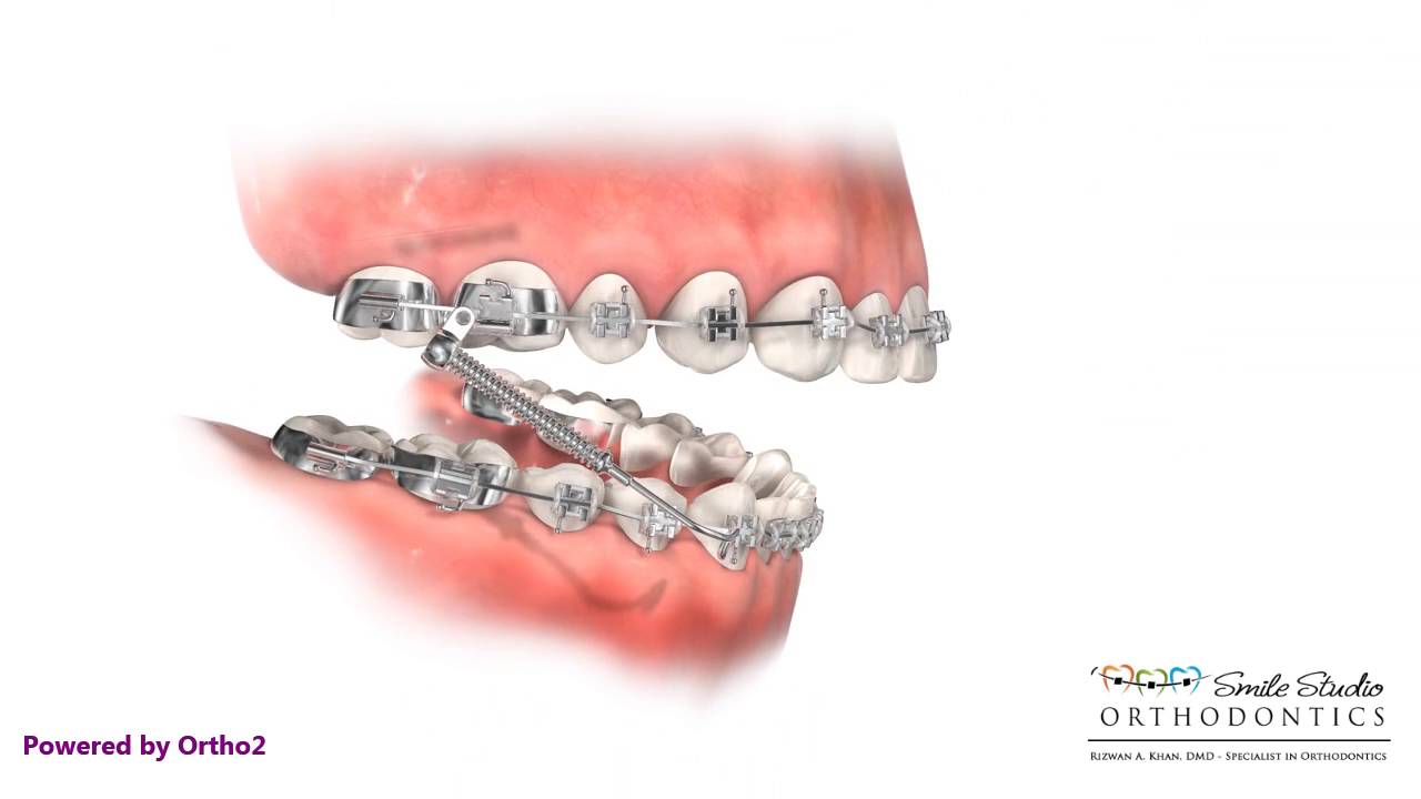 orthodontic appliances