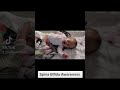 Compilation of little girl named lacey grace born with mmc spina bifida  laughlikelacey