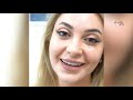 Jawline fillers treatment performed by dr mona ragab