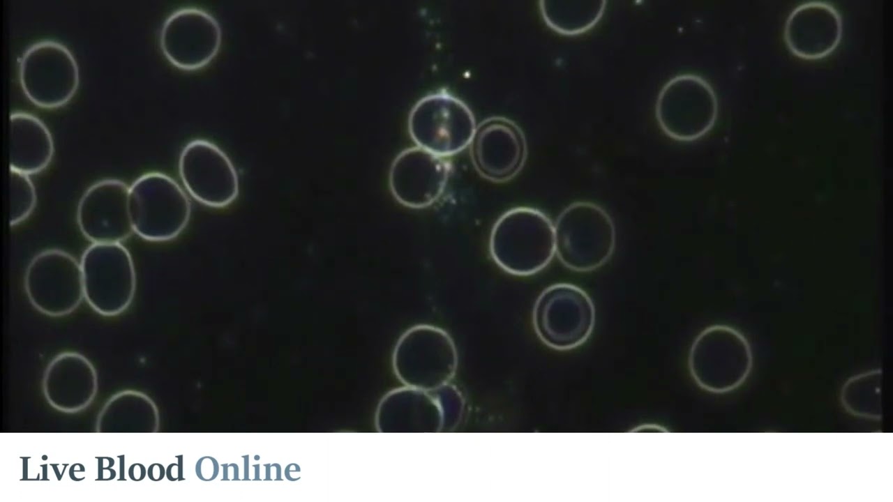 Possible Anaemia Seen in Live Blood Analysis - Live Blood Analysis Training Course