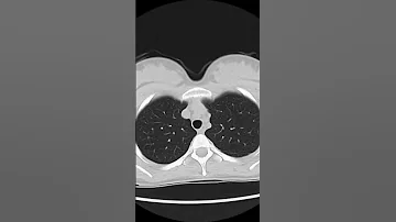 Normal Chest CT Of Lungs 