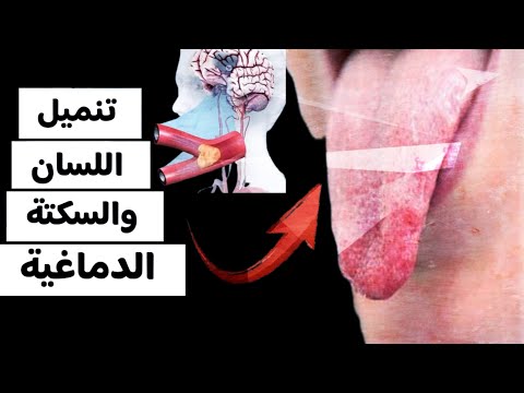 تنميل اللسان والسكتة الدماغية احذر من هذه العلامة تنميل اللسان والسكتة الدماغية احذر من هذه العلامة
