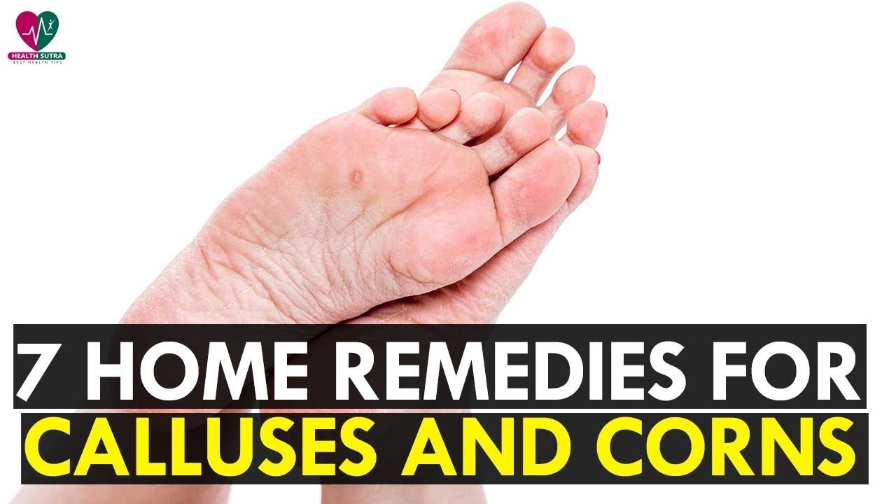 7 Best Home Remedies For Calluses And Corns