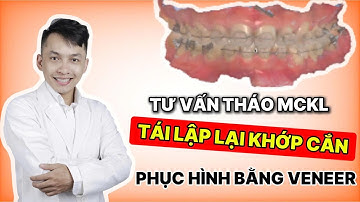 Tìm Lại Nụ Cười Sau 3,5 Năm Niềng Răng – Khi Niềm Tin Gặp Đúng Bác Sĩ | Dán Sứ Veneer Không Mài