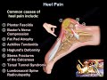 Heel pain causes and treatment plantar fasciitis diagnosis and treatment