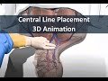Learn about central line placement with 3d animation