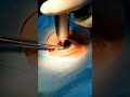 cataract surgery for eye#cataract #eyes #ophthalmology #health #doctor #hospital #vision #surgeon