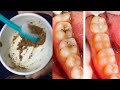 Heal Receding Gums and Grow Back || how to get rid of cavity | పిప్పి పన్నుకి 5 నిమిషాల్లో పరిష్కారం