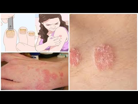 Βίντεο: Τι προκαλούν οι ασθένειες του δέρματος;