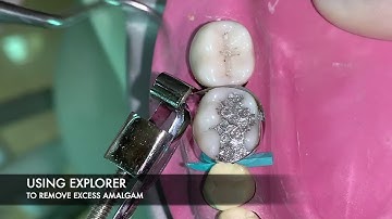 Class II Amalgam Restoration