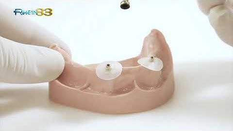 Direct Roots Overdenture Restorations: Spherical and Ot Equator titanium Pivots