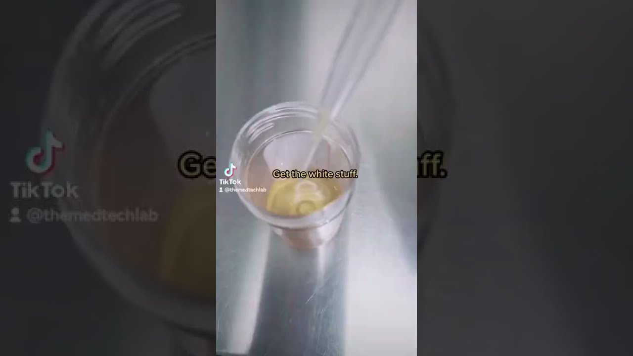White Particles In Urine Microscope Urinalysis Laboratory Clinicalmicroscopy