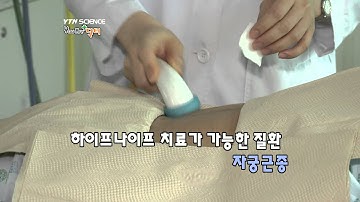 YTN SCIENCE 하이푸 나이프고강도 집속 초음파 치료