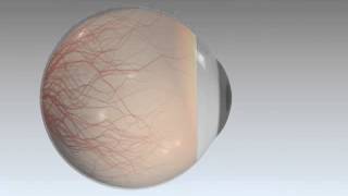 EYE 05 Aqueous Fluid