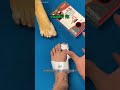 Toe Corrector for Bunions: Why This Device is a Game Changer for Foot Alignment