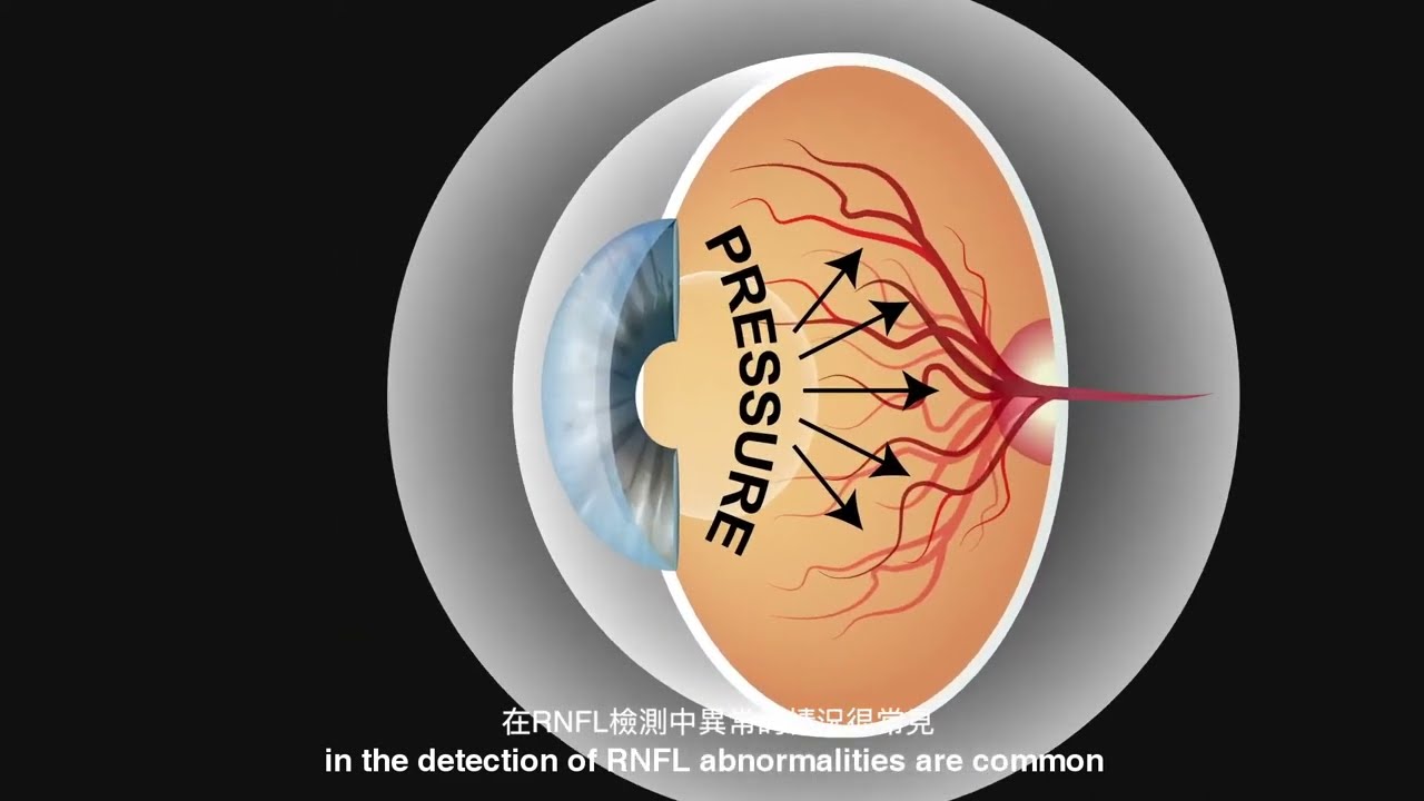 視網膜神經纖維層光學紋理分析 Retinal Nerve Fiber Layer Optical Texture Analysis