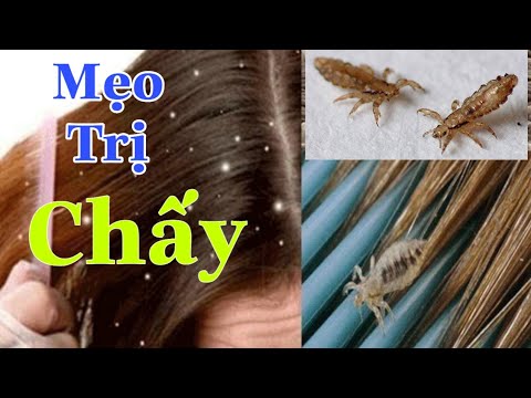 Video: Cách trị Chấy ở Đầu bằng Giấm: 8 Bước (Có Hình ảnh)